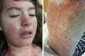 Rocky Mountain Spotted Fever